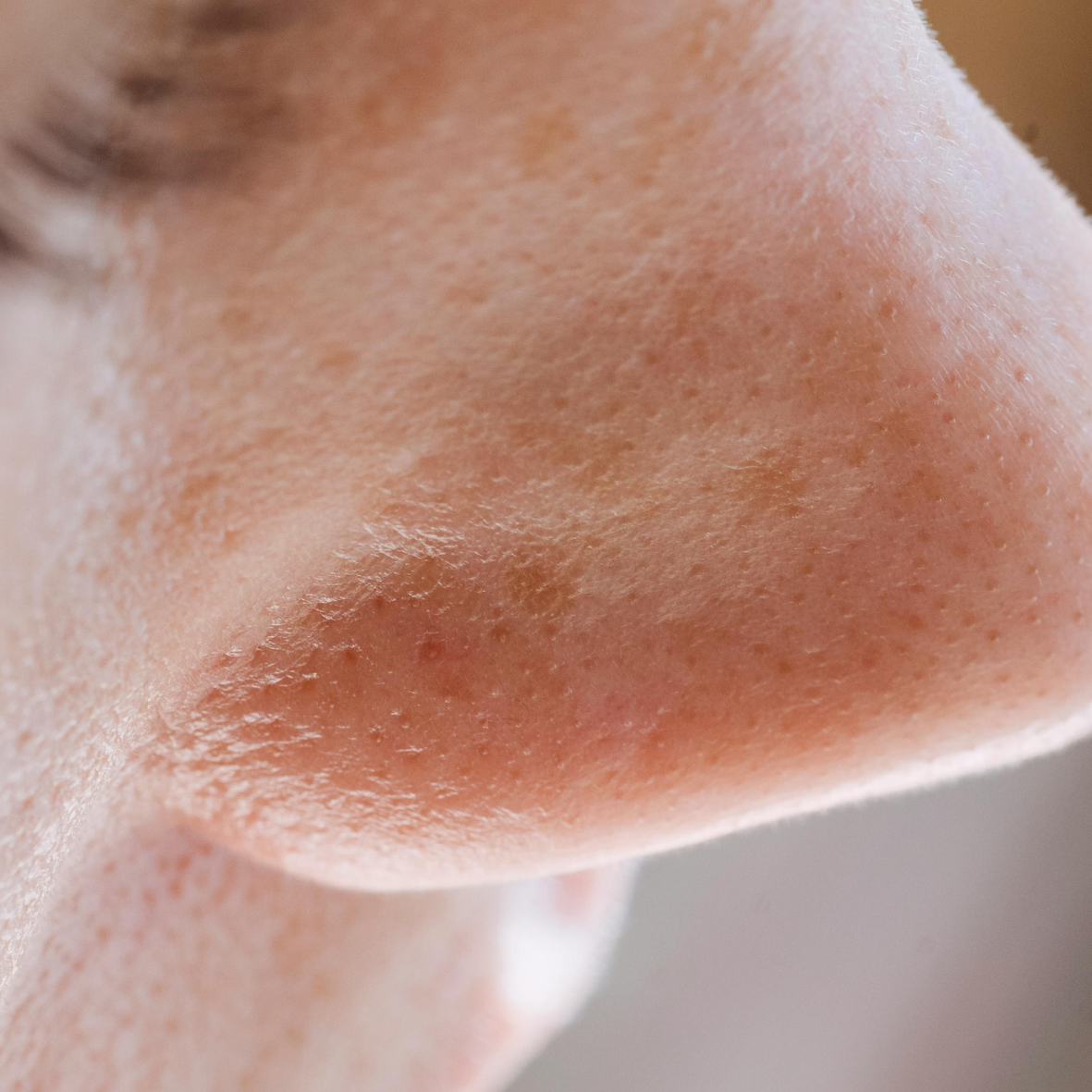 Comment réduire l’apparence des pores dilatés avec des soins adaptés 
