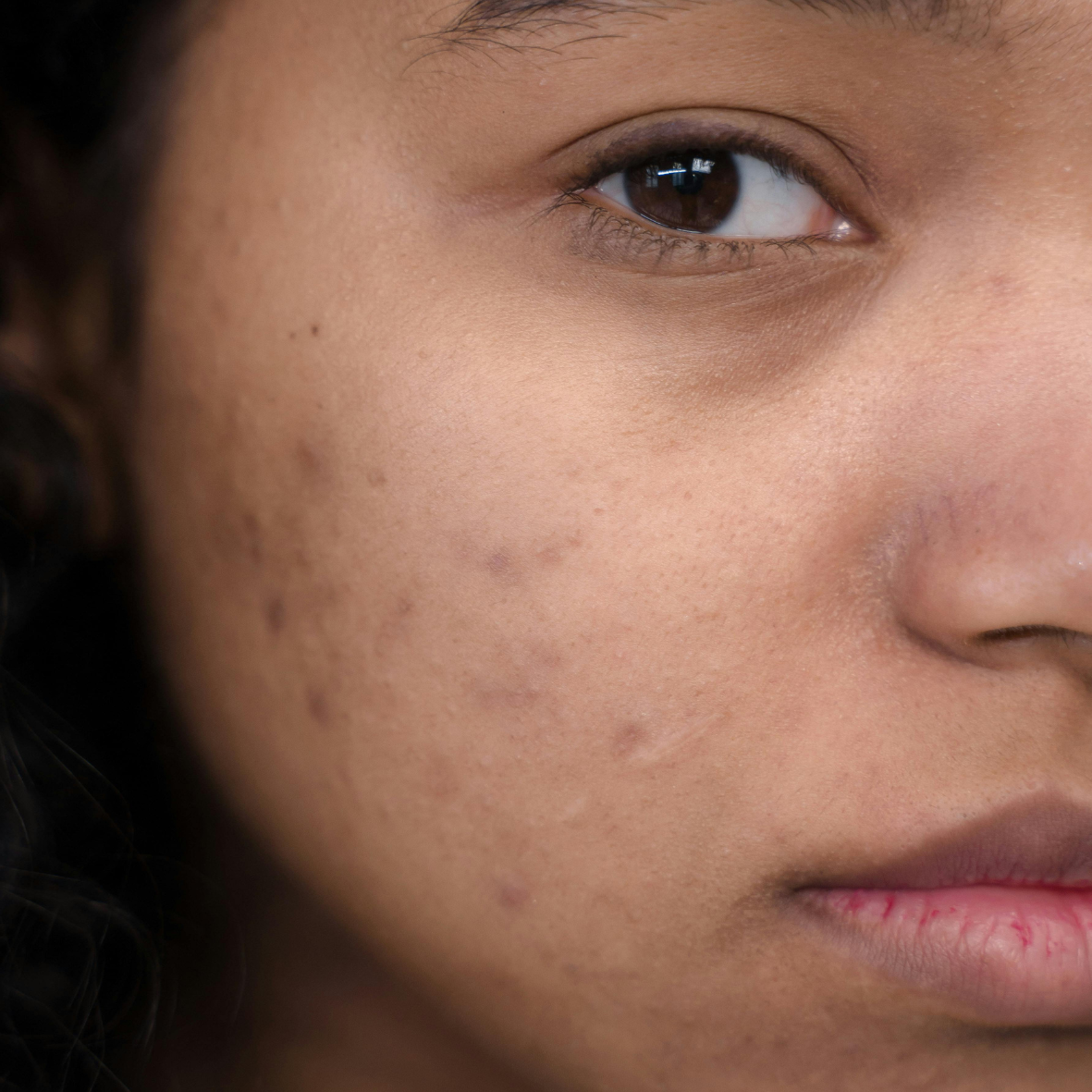 Hyperpigmentation : solutions pour atténuer les taches brunes et uniformiser le teint